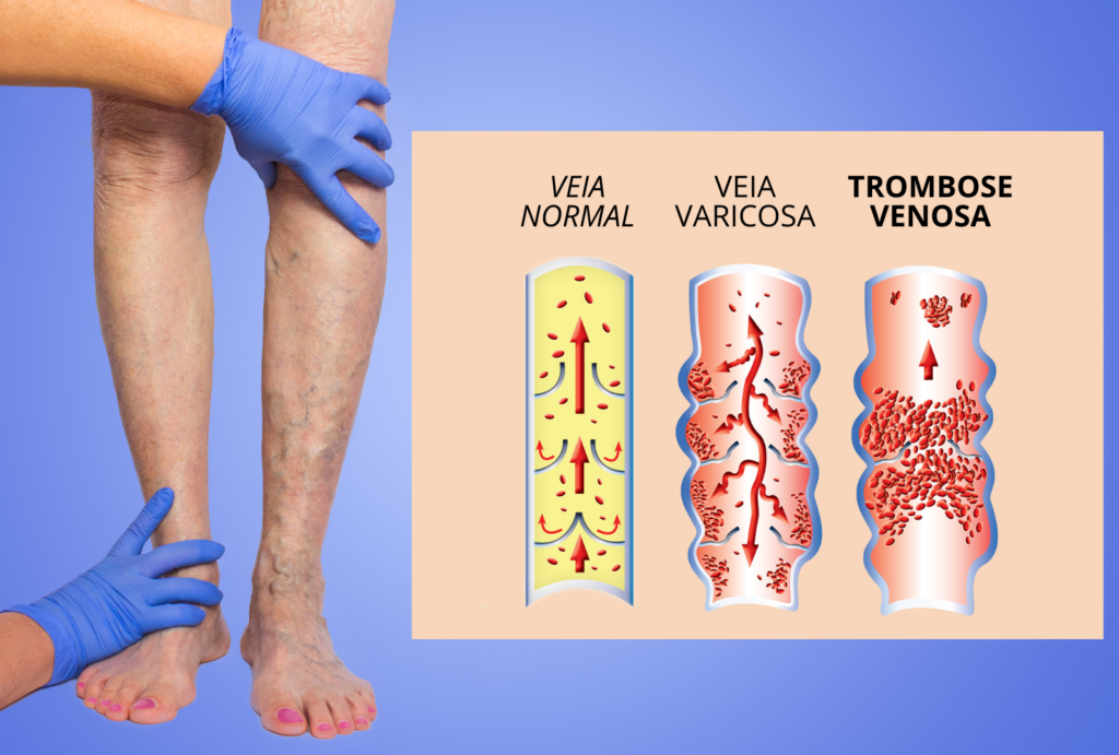 gráfico explicativo varizes e trombose