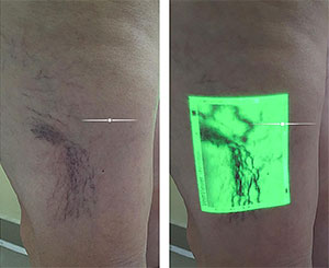 aparelho visualizador de veias no auxílio ao tratamento de varizes 4