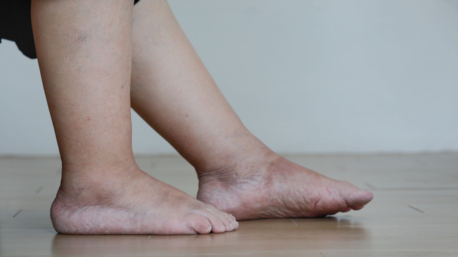 Leia mais sobre o artigo 10 Causas de inchaço nas pernas que NÃO são Varizes
