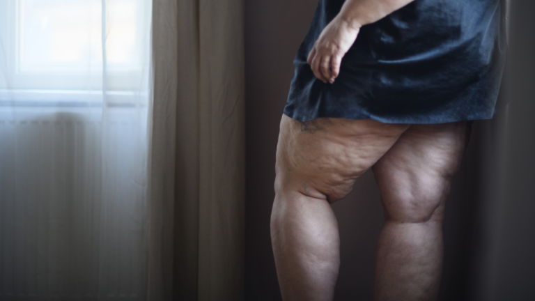 Leia mais sobre o artigo TUDO que eu sei sobre LIPEDEMA